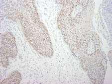 DDX21 Antibody - Detection of Human DDX21 by Immunohistochemistry. Sample: FFPE section of human larynx squamous cell carcinoma. Antibody: Affinity purified rabbit anti-DDX21 used at a dilution of 1:250.