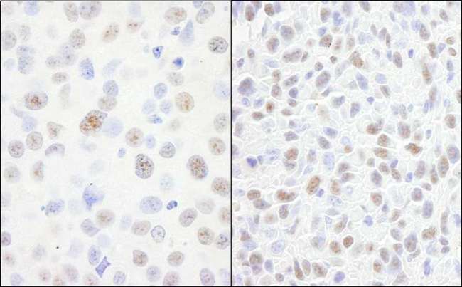 DDX21 Antibody - Detection of Human and Mouse DDX21 by Immunohistochemistry. Sample: FFPE section of human breast carcinoma (left) and mouse squamous cell carcinoma (right). Antibody: Affinity purified rabbit anti-DDX21 used at a dilution of 1:200 (1 ug/ml). Detection: DAB.