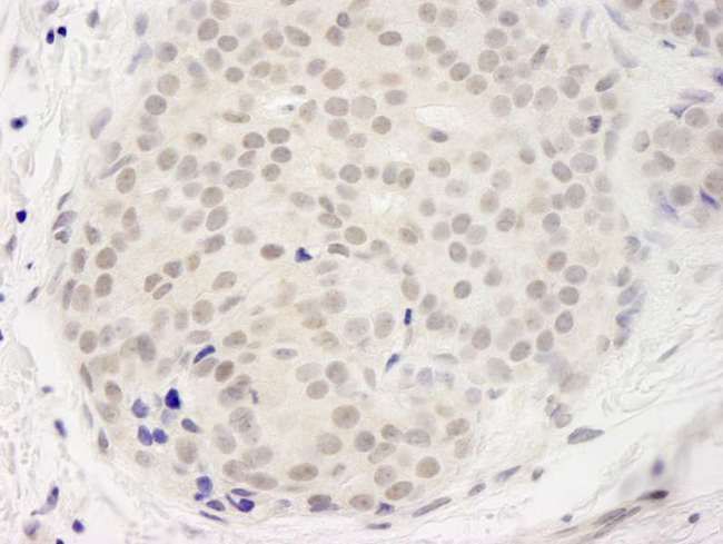 DDX23 / PRP28 Antibody - Detection of Human DDX23 by Immunohistochemistry. Sample: FFPE section of human breast carcinoma. Antibody: Affinity purified rabbit anti-DDX23 used at a dilution of 1:250. Epitope Retrieval Buffer-High pH (IHC-101J) was substituted for Epitope Retrieval Buffer-Reduced pH.