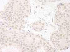 DDX23 / PRP28 Antibody - Detection of Human DDX23 by Immunohistochemistry. Sample: FFPE section of human breast carcinoma. Antibody: Affinity purified rabbit anti-DDX23 used at a dilution of 1:200 (1 ug/ml). Detection: DAB.