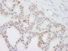 DDX24 Antibody - Detection of Human DDX24 by Immunohistochemistry. Sample: FFPE section of human ovarian tumor. Antibody: Affinity purified rabbit anti-DDX24 used at a dilution of 1:250.