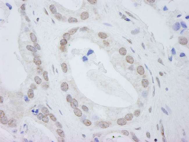 DDX24 Antibody - Detection of Human DDX24 by Immunohistochemistry. Sample: FFPE section of human prostate adenocarcinoma. Antibody: Affinity purified rabbit anti-DDX24 used at a dilution of 1:250.