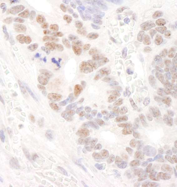 DDX24 Antibody - Detection of Human DDX24 by Immunohistochemistry. Sample: FFPE section of human ovarian carcinoma. Antibody: Affinity purified rabbit anti-DDX24 used at a dilution of 1:200 (1 ug/ml). Detection: DAB.
