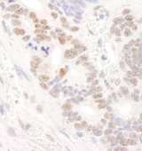 DDX24 Antibody - Detection of Human DDX24 by Immunohistochemistry. Sample: FFPE section of human ovarian carcinoma. Antibody: Affinity purified rabbit anti-DDX24 used at a dilution of 1:200 (1 ug/ml). Detection: DAB.