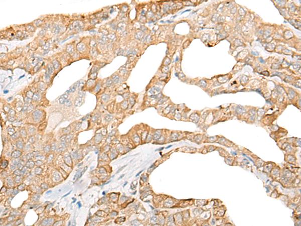 DDX24 Antibody - Immunohistochemistry of paraffin-embedded Human thyroid cancer tissue  using DDX24 Polyclonal Antibody at dilution of 1:35(×200)