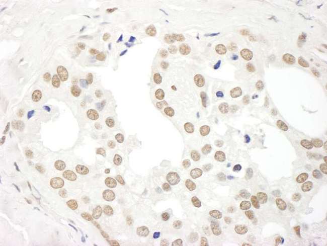 DDX27 Antibody - Detection of Human DDX27 by Immunohistochemistry. Sample: FFPE section of human prostate carcinoma. Antibody: Affinity purified rabbit anti-DDX27 used at a dilution of 1:500.