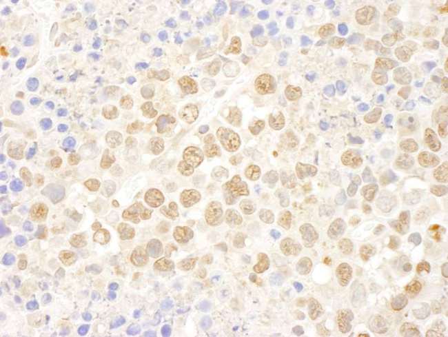DDX27 Antibody - Detection of Mouse DDX27 by Immunohistochemistry. Sample: FFPE section of mouse hybridoma tumor. Antibody: Affinity purified rabbit anti-DDX27 used at a dilution of 1:100.