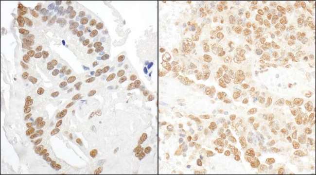 DDX27 Antibody - Detection of Human and Mouse DDX27 by Immunohistochemistry. Sample: FFPE section of human prostate carcinoma (left) and mouse teratoma (right). Antibody: Affinity purified rabbit anti-DDX27 used at a dilution of 1:5000 (0.2 ug/ml) and 1:1000 (1 ug/ml). Detection: DAB.