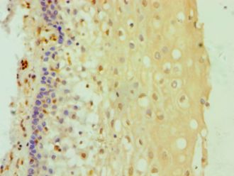 DDX3 / DDX3X Antibody - Immunohistochemistry of paraffin-embedded human cervical cancer using antibody at 1:100 dilution.