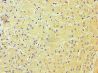 DDX3 / DDX3X Antibody - Immunohistochemistry of paraffin-embedded human liver cancer using antibody at 1:100 dilution.