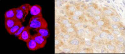 DDX3 / DDX3X Antibody - Detection of Human and Mouse DDX3 by Immunohistochemistry. Sample: FFPE section of human lung cancer pleural effusion (left) and mouse renal cell carcinoma (right). Antibody: Affinity purified rabbit anti-DDX3 used at a dilution of 1:200 (1 ug/ml). Detection: Red fluorescence (A120-601D4) and DAB.