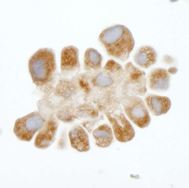 DDX3 / DDX3X Antibody - Detection of Human DDX3 by Immunohistochemistry. Sample: FFPE section of human NSCLC pleural effusion. Antibody: Affinity purified rabbit anti-DDX3 used at a dilution of 1:250.