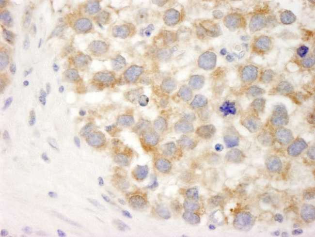 DDX3 / DDX3X Antibody - Detection of Human DDX3 by Immunohistochemistry. Sample: FFPE section of human seminoma. Antibody: Affinity purified rabbit anti-DDX3 used at a dilution of 1:250.