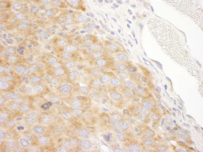 DDX3 / DDX3X Antibody - Detection of Mouse DDX3 by Immunohistochemistry. Sample: FFPE section of mouse renal cell carcinoma. Antibody: Affinity purified rabbit anti-DDX3 used at a dilution of 1:250.