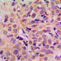 DDX3 / DDX3X Antibody - Immunohistochemical analysis of DDX3X staining in human breast cancer formalin fixed paraffin embedded tissue section. The section was pre-treated using heat mediated antigen retrieval with sodium citrate buffer (pH 6.0). The section was then incubated with the antibody at room temperature and detected using an HRP conjugated compact polymer system. DAB was used as the chromogen. The section was then counterstained with hematoxylin and mounted with DPX.