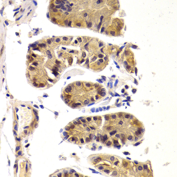DDX3 / DDX3X Antibody - Immunohistochemistry of paraffin-embedded human breast cancer tissue.
