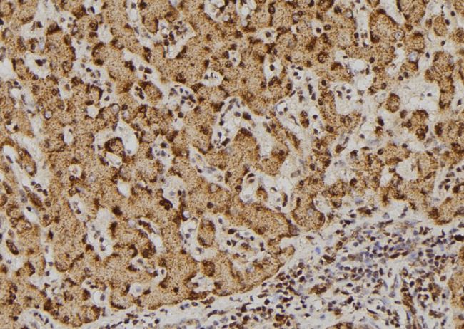 DDX3 / DDX3X Antibody - 1:100 staining human liver tissue by IHC-P. The sample was formaldehyde fixed and a heat mediated antigen retrieval step in citrate buffer was performed. The sample was then blocked and incubated with the antibody for 1.5 hours at 22°C. An HRP conjugated goat anti-rabbit antibody was used as the secondary.