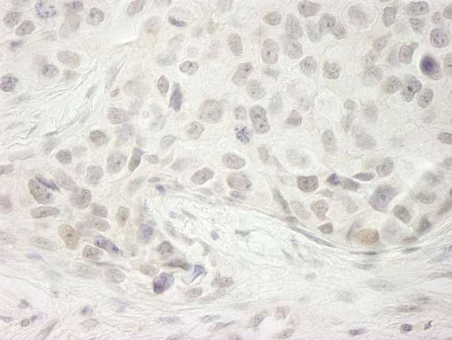 DDX33 / DHX33 Antibody - Detection of Human DHX33 by Immunohistochemistry. Sample: FFPE section of human breast carcinoma. Antibody: Affinity purified rabbit anti-DHX33 used at a dilution of 1:250. Epitope Retrieval Buffer-High pH (IHC-101J) was substituted for Epitope Retrieval Buffer-Reduced pH.