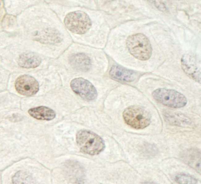 DDX33 / DHX33 Antibody - Detection of Human DHX33 by Immunohistochemistry. Sample: FFPE section of human breast carcinoma. Antibody: Affinity purified rabbit anti-DHX33 used at a dilution of 1:250. Epitope Retrieval Buffer-High pH (IHC-101J) was substituted for Epitope Retrieval Buffer-Reduced pH.