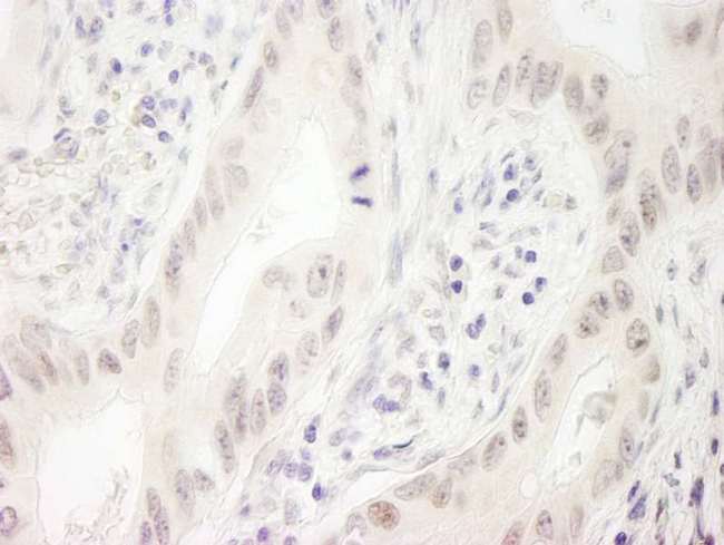 DDX33 / DHX33 Antibody - Detection of Human DHX33 by Immunohistochemistry. Sample: FFPE section of human lung carcinoma. Antibody: Affinity purified rabbit anti-DHX33 used at a dilution of 1:1000 (1 ug/ml). Detection: DAB.