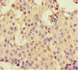 DDX33 / DHX33 Antibody - Immunohistochemistry of paraffin-embedded human breast cancer at dilution 1:100