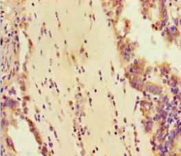 DDX33 / DHX33 Antibody - Immunohistochemistry of paraffin-embedded human lung cancer at dilution 1:100