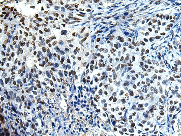 DDX39 Antibody - Immunohistochemistry of paraffin-embedded Human esophagus cancer tissue  using DDX39A Polyclonal Antibody at dilution of 1:65(×200)