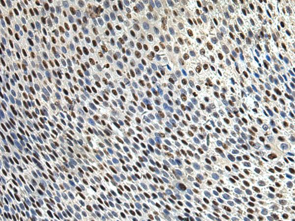 DDX39 Antibody - Immunohistochemistry of paraffin-embedded Human lung cancer tissue  using DDX39A Polyclonal Antibody at dilution of 1:65(×200)
