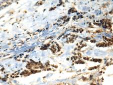 DDX39 Antibody - Immunohistochemistry of paraffin-embedded Human breast cancer tissue  using DDX39A Polyclonal Antibody at dilution of 1:70(×200)