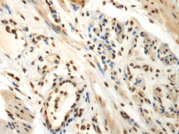 DDX39 Antibody - Immunohistochemistry of paraffin-embedded Human thyroid cancer tissue  using DDX39A Polyclonal Antibody at dilution of 1:70(×200)