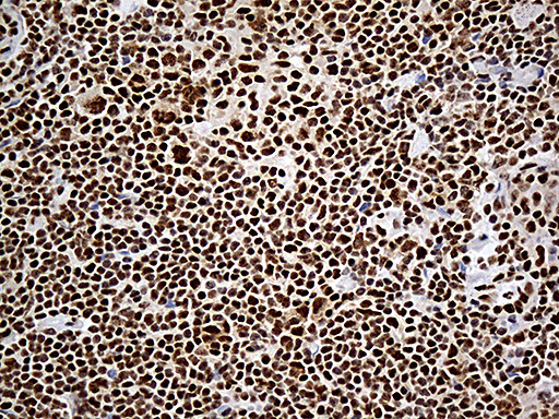 DDX39B / UAP56 Antibody - Immunohistochemical staining of paraffin-embedded Human lymphoma tissue using anti-DDX39B mouse monoclonal antibody. (Heat-induced epitope retrieval by 1mM EDTA in 10mM Tris buffer. (pH8.5) at 120°C for 3 min. (1:500)