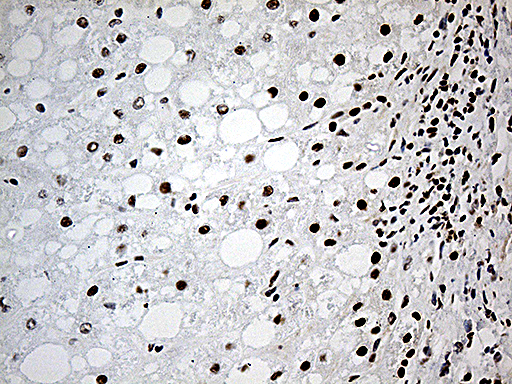 DDX39B / UAP56 Antibody - Immunohistochemical staining of paraffin-embedded Carcinoma of Human liver tissue using anti-DDX39B mouse monoclonal antibody. (Heat-induced epitope retrieval by 1mM EDTA in 10mM Tris buffer. (pH8.5) at 120°C for 3 min. (1:500)