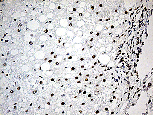 DDX39B / UAP56 Antibody - Immunohistochemical staining of paraffin-embedded Carcinoma of Human liver tissue using anti-DDX39B mouse monoclonal antibody. (Heat-induced epitope retrieval by 1mM EDTA in 10mM Tris buffer. (pH8.5) at 120°C for 3 min. (1:500)