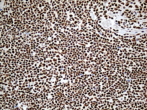 DDX39B / UAP56 Antibody - Immunohistochemical staining of paraffin-embedded Human lymphoma tissue using anti-DDX39B mouse monoclonal antibody. (Heat-induced epitope retrieval by 1mM EDTA in 10mM Tris buffer. (pH8.5) at 120°C for 3 min. (1:500)