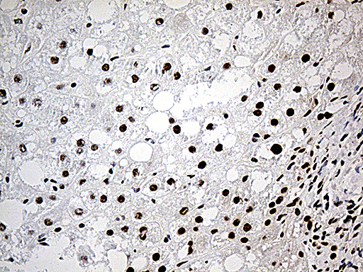 DDX39B / UAP56 Antibody - Immunohistochemical staining of paraffin-embedded Carcinoma of Human liver tissue using anti-DDX39B mouse monoclonal antibody. (Heat-induced epitope retrieval by 1mM EDTA in 10mM Tris buffer. (pH8.5) at 120°C for 3 min. (1:500)