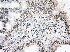 DDX39B / UAP56 Antibody - IHC of paraffin-embedded Adenocarcinoma of Human colon tissue using anti-BAT1 mouse monoclonal antibody. (Dilution 1:50).