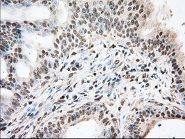 DDX39B / UAP56 Antibody - IHC of paraffin-embedded Adenocarcinoma of Human colon tissue using anti-BAT1 mouse monoclonal antibody. (Dilution 1:50).