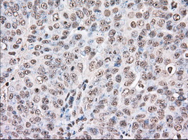 DDX39B / UAP56 Antibody - IHC of paraffin-embedded Adenocarcinoma of Human ovary tissue using anti-BAT1 mouse monoclonal antibody. (Dilution 1:50).