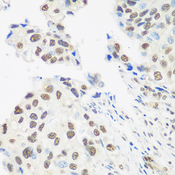 DDX39B / UAP56 Antibody - Immunohistochemistry of paraffin-embedded human prostate cancer tissue.