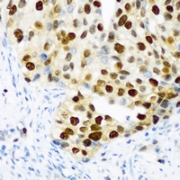 DDX39B / UAP56 Antibody - Immunohistochemical analysis of DDX39B staining in human prostate cancer formalin fixed paraffin embedded tissue section. The section was pre-treated using heat mediated antigen retrieval with sodium citrate buffer (pH 6.0). The section was then incubated with the antibody at room temperature and detected using an HRP conjugated compact polymer system. DAB was used as the chromogen. The section was then counterstained with hematoxylin and mounted with DPX.
