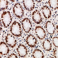 DDX39B / UAP56 Antibody - Immunohistochemical analysis of DDX39B staining in human colon cancer formalin fixed paraffin embedded tissue section. The section was pre-treated using heat mediated antigen retrieval with sodium citrate buffer (pH 6.0). The section was then incubated with the antibody at room temperature and detected using an HRP conjugated compact polymer system. DAB was used as the chromogen. The section was then counterstained with haematoxylin and mounted with DPX.