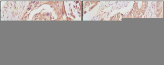 DDX4 / VASA Antibody - IHC of paraffin-embedded human lung cancer (A) and rectal cancer (B), showing cytoplasmic localization using DDX4 mouse monoclonal antibody with DAB staining.