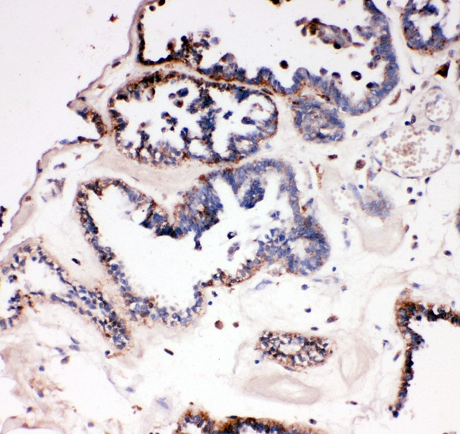DDX4 / VASA Antibody - IHC analysis of DDX4/MVH using anti-DDX4/MVH antibody. DDX4/MVH was detected in paraffin-embedded section of human ovarian cancer tissue. Heat mediated antigen retrieval was performed in citrate buffer (pH6, epitope retrieval solution) for 20 mins. The tissue section was blocked with 10% goat serum. The tissue section was then incubated with 1µg/ml rabbit anti-DDX4/MVH antibody overnight at 4°C. Biotinylated goat anti-rabbit IgG was used as secondary antibody and incubated for 30 minutes at 37°C. The tissue section was developed using Strepavidin-Biotin-Complex (SABC) with DAB as the chromogen.