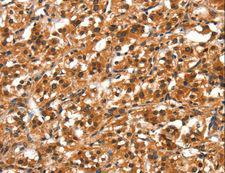 DDX4 / VASA Antibody - Immunohistochemistry of paraffin-embedded Human gastric cancer using DDX4 Polyclonal Antibody at dilution of 1:40.