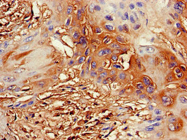 DDX4 / VASA Antibody - Immunohistochemistry of paraffin-embedded human cervical cancer at dilution of 1:100
