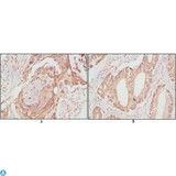 DDX4 / VASA Antibody - Immunohistochemistry (IHC) analysis of paraffin-embedded human lung cancer (A) and rectal cancer (B), showing cytoplasmic localization with DAB staining using DDX4 Monoclonal Antibody.