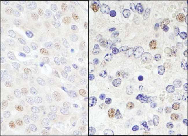 DDX46 Antibody - Detection of Human and Mouse DDX46 by Immunohistochemistry. Sample: FFPE section of human breast carcinoma (left) and mouse teratoma (right). Antibody: Affinity purified rabbit anti-DDX46 used at a dilution of 1:1000 (0.2 ug/ml). Detection: DAB.