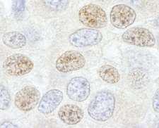 DDX46 Antibody - Detection of Human DDX46 by Immunohistochemistry. Sample: FFPE section of human breast carcinoma. Antibody: Affinity purified rabbit anti-DDX46 used at a dilution of 1:250.