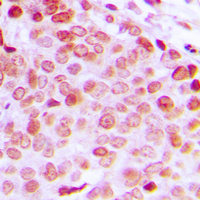 DDX5 Antibody - Immunohistochemical analysis of DDX5 (pY593) staining in human prostate cancer formalin fixed paraffin embedded tissue section. The section was pre-treated using heat mediated antigen retrieval with sodium citrate buffer (pH 6.0). The section was then incubated with the antibody at room temperature and detected using an HRP conjugated compact polymer system. DAB was used as the chromogen. The section was then counterstained with hematoxylin and mounted with DPX.