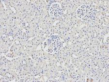 DDX5 Antibody - Immunohistochemistry of paraffin-embedded human thyroid cancer using DDX5 antibody at dilution of 1:200 (200x lens).
